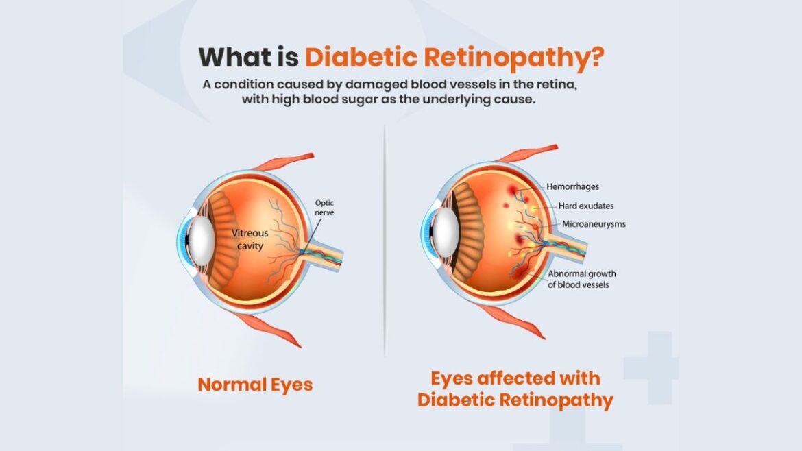 Can Diabetic Retinopathy Be Reversed?